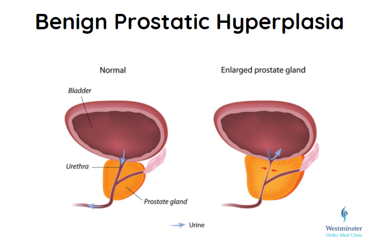 benign prostatic hyperplasia( bph))
